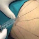 Aqualyx – injection de perte de poids