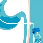 AspireAssist est une sonde gastrique qui est conçue pour aider les gens qui souhaitent aspirer